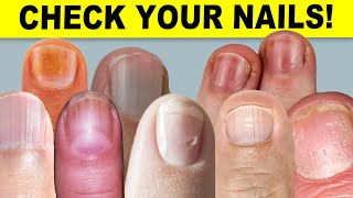 9 Things Your Nails Can Tell You About Your Health [upl. by Kovacs156]