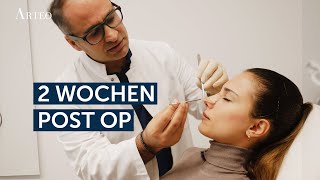 Geschlossene NasenOP bei voroperierter Nase  VorherNachher Ergebnis nach 2 Wochen [upl. by Darell]