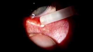 Meibomian cyst expressed [upl. by Epuladaug]