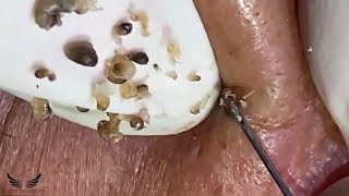 Cystic Acne Blackhead Removal  Elderly Hidden Acne Treatment  Pimple Popping Spa Extraction  060 [upl. by Bills]