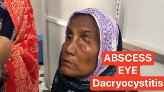 Abscess formation  Dacryocystitis  eye [upl. by Traver]