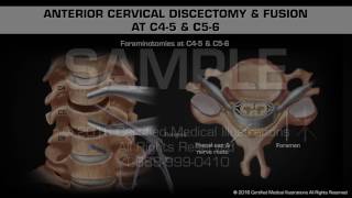 Anterior Cervical Discectomy amp Fusion at C45 amp C56 [upl. by Dlorah]