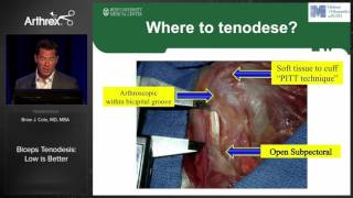 Biceps Tenodesis Low is Better [upl. by Euqininod]