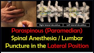 quotHowToquot Guide  Paraspinous Lumbar Puncture  Spinal Anesthesia Lateral Position [upl. by Oric]