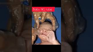 Nasogastric tube in children [upl. by Ileana65]