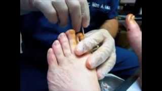 Podiatrist Cures Ingrown Toenail [upl. by Nadroj]