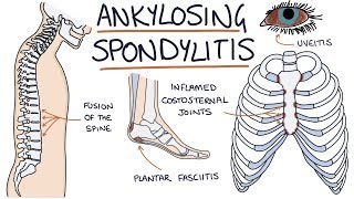 Ankylosing Spondylitis Visual Explanation for Students [upl. by Cirtemed461]