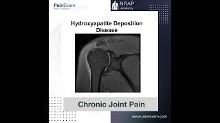 Hydroxyapatite Deposition Disease [upl. by Eimareg478]