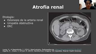 Hipoplasia renal  Malformaciones renales [upl. by Cirred]