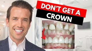 Watch this before getting a Dental Crown [upl. by Ilse]