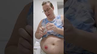 ileostomy supplies and bag change ostomycare ostomy ileostomy stoma Hollister analcancer [upl. by Eadmund851]