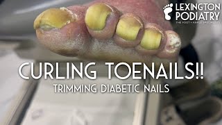 Curling Toenails Trimming Diabetic Nails [upl. by Jon177]