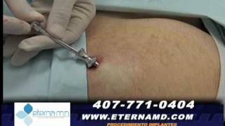 TESTOSTERONE PELLETS procedure live  2 [upl. by Eicram]