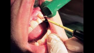 Gingivectomy hf surg [upl. by Valentino727]