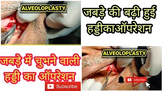 Alveoloplasty  bone removal surgerybony spicule removal in old patient draquil5454 [upl. by Asiul313]