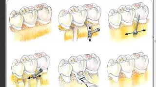 Resective Osseous Surgery [upl. by Nessaj629]