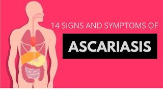 14 SIGNS AND SYMPTOMS OF ASCARIASIS [upl. by Cristionna]