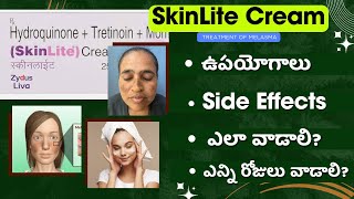 How to Use Skinlite Cream for Melasma  Benefits Side Effects and Precautions [upl. by Centonze]