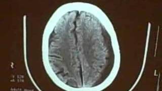 Subdural hematoma [upl. by Carpet]