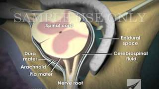 Loss of Pressure Epidural Injection [upl. by Kcarb]