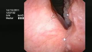 Cancer of the larynx voicebox  wwwdrjeevecom [upl. by Collier]