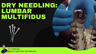 Dry Needling Multifidus [upl. by Llekcir]