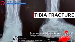 Comminuted Tibia Fracture [upl. by Mann]