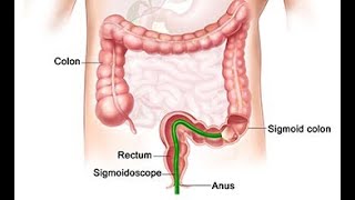 Flexible Sigmoidoscopy  Definition Uses Steps procedure Indications Contraindications [upl. by Ebbie262]