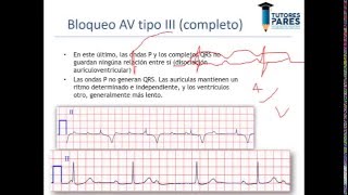 Arritmias en el electrocardiograma [upl. by Anivlac]