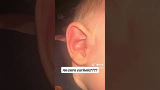 Baby’s swollen ear pit preauricularpit asmr pimple [upl. by Oram]