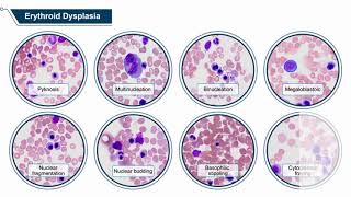 Secondary AML Through the Microscope A PathologyInformed Guide to Modern Diagnostic and Treatment [upl. by Hras70]