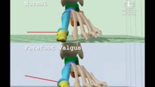 Comparison of Normal Gait to Forefoot Valgus Gait [upl. by Ashman203]