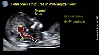 Open spina bifida at 1113 weeks gestation brainstem [upl. by Crowe770]