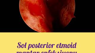 Sol posterior etmoid mantar enfeksiyonu Left posterior ethmoid fungal sinusitis [upl. by Anitsuj]