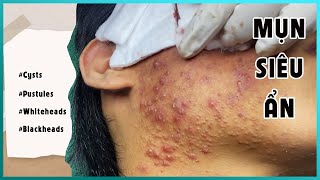 Big Cystic Acne Blackheads Extraction Blackheads amp Milia Whiteheads Removal Pimple Popping [upl. by Semreh]