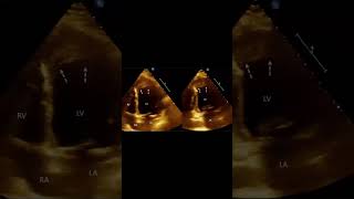 If you think it is laminated thrombus you are wrong and patient can crash with anticoagulants [upl. by Carlos]