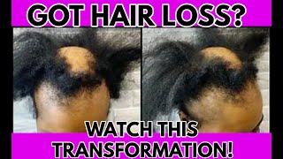 HAVE YOU TRIED THIS l PASSION TWIST l ALOPECIA l BALD SPOT COVER UP METHOD [upl. by Adanama]