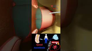 Epidural  Spinal Anesthesia  Lumbar Puncture [upl. by Kosel]