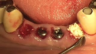 Socket preservation using alloplastic graft material OSTEON™ [upl. by Aeslek]