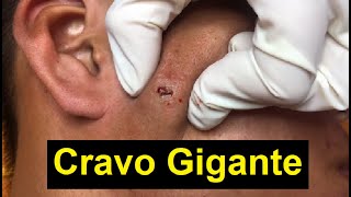 Tratamento cravos e espinhas  Cravo gigante inflamado [upl. by Ainslee]