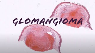 GlomangiomaGlomuvenous Malformation glomus tumor with lots of vessels pathology dermatology [upl. by Frangos]