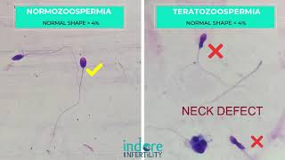 Teratozoospermia  Poor Morphology Sperms Comparison with Normal morhology sperms  Normozoospermia [upl. by Danaher]