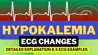 ECG Changes in Hypokalemia  Hypokalemia ECG Changes  Detailed Explanation [upl. by Burtie]