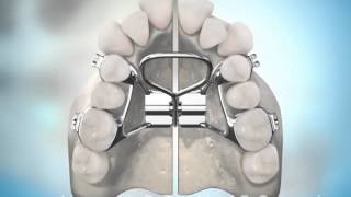 Surgically Assisted Palatal Expansion [upl. by Asen]