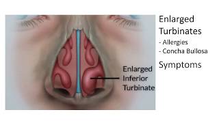 Enlarged Nasal Turbinates Symptoms and Treatment [upl. by Nelav]