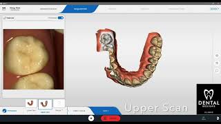 Dental Crown Singapore  CEREC PrimeScan Scanning [upl. by Trevar]