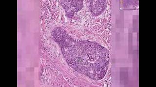 Histopathology Cervix Squamous cell carcinoma [upl. by Oah951]