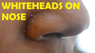 Deep Blackheads Removal from Cheeks and Nose  Best Blackheads Removal Video II Dr lalit kasana II [upl. by Delanie]