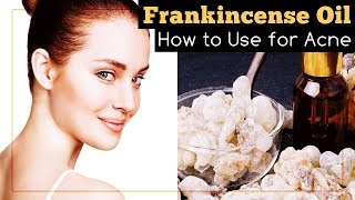 Frankincense Essential Oil for Acne How to Use It [upl. by Anomor962]