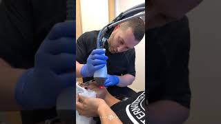 SEE HOW ACNE SCARS ARE IMPROVED WITH FRAXEL LASER IN DARKER SKIN TYPES  DR JASON EMER [upl. by Citarella]